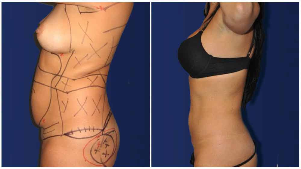 vista lateral del torso de una mujer desnuda - antes y después de la eliminación de grasa por liposucción