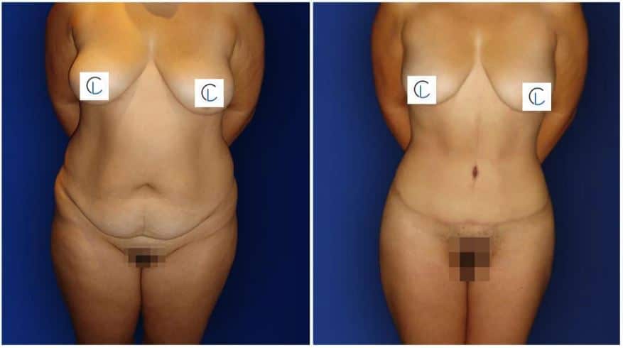 abdominoplastia en paciente femenina mostrando el cambio significativo en la reduccion de piel suelta en su abdomen