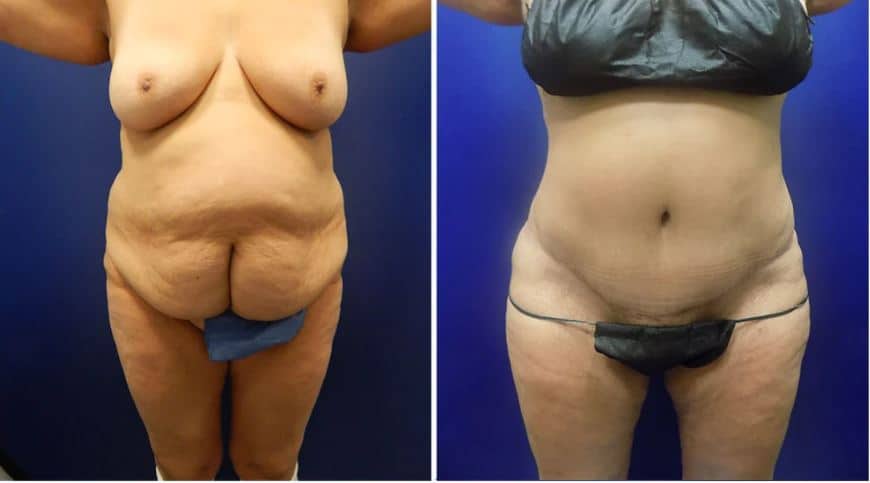 abdominoplastia antes y despues con reduccion massiva de piel colgante en el estomago