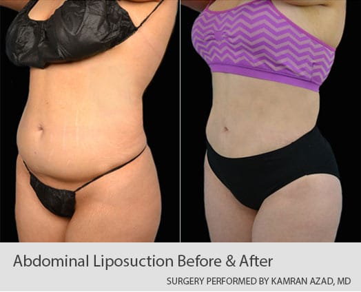 Stomach and Abdomen Liposuction  Abdomen Liposuction Near Charlotte