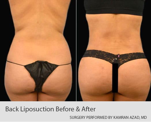 Back Liposuction Patient Picture
