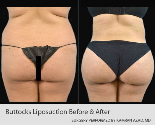 Buttocks liposuction Orlando