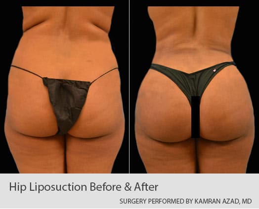 High-Definition Liposuction in Orlando, FL - Plastic Surgery in