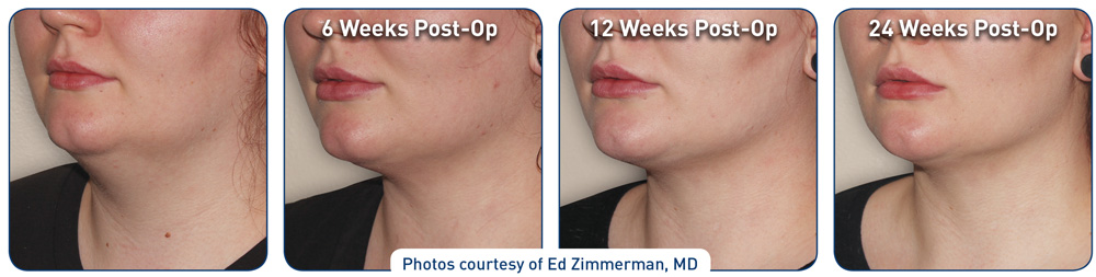 El procedimiento Miracle Skin Tightening y su progreso de recuperacion desde el dia 1 hasta las 24 semanas